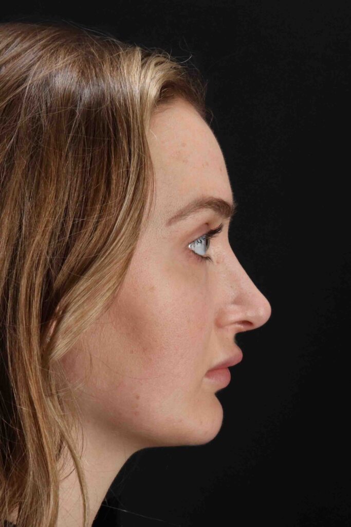 Before - right_lateral