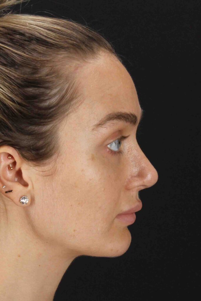 After - right_lateral