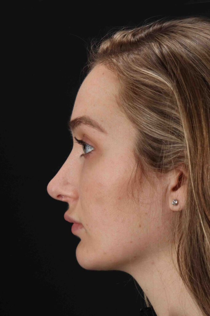 Before - left_lateral