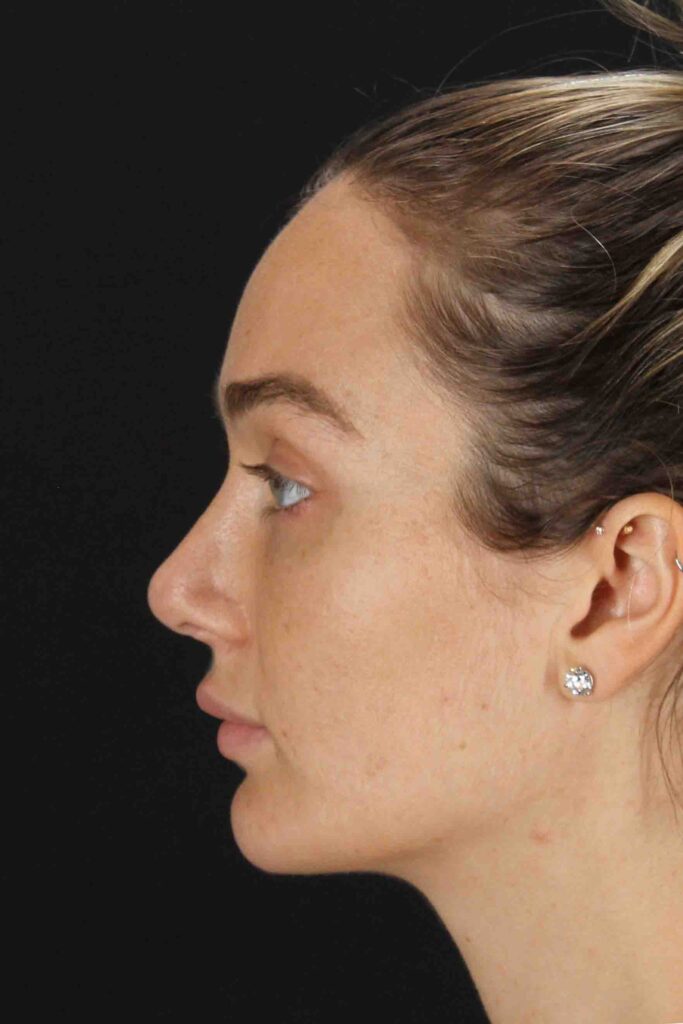 After - left_lateral