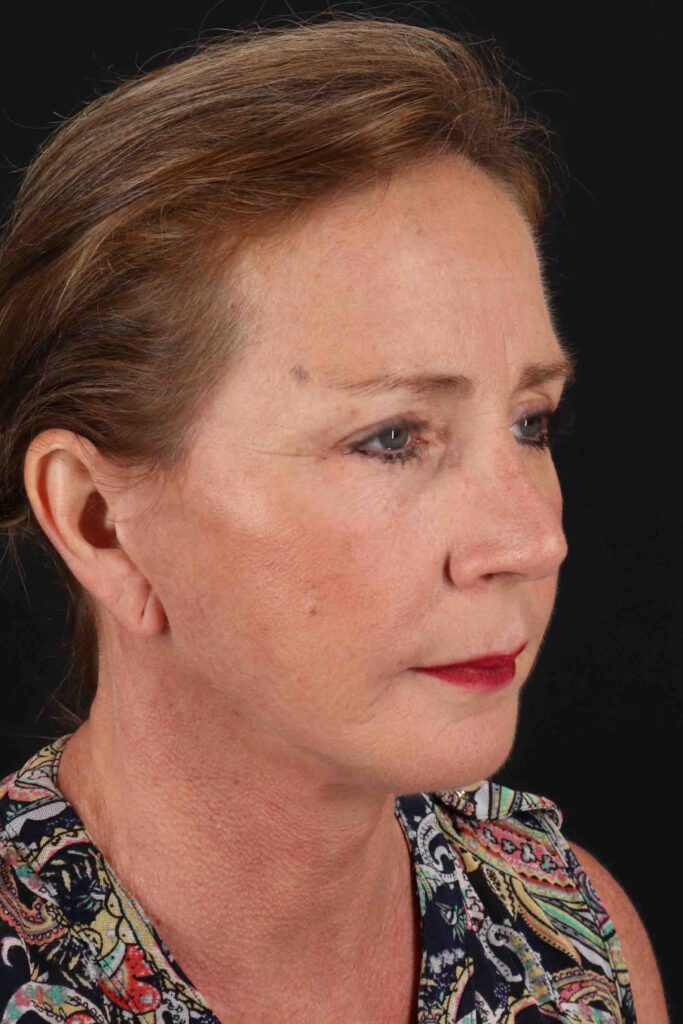 After - right_oblique