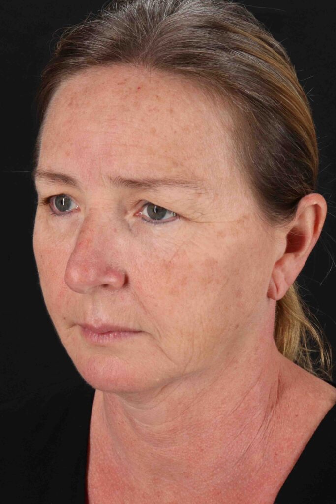 Before - left_oblique