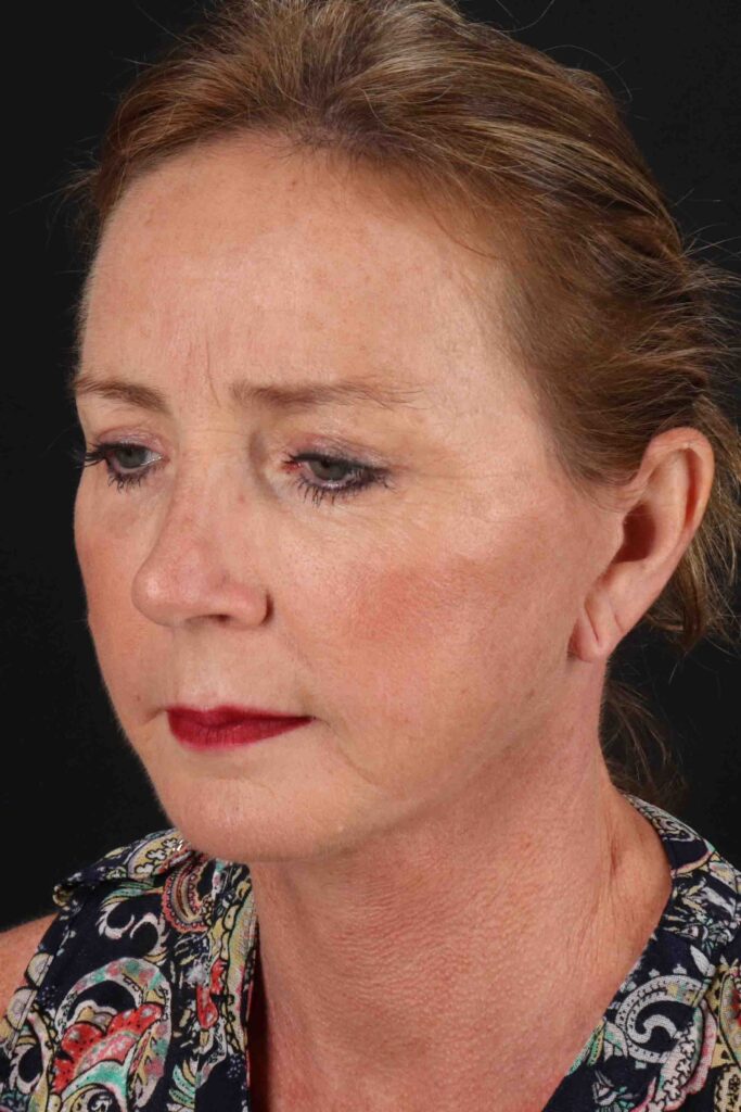 After - left_oblique