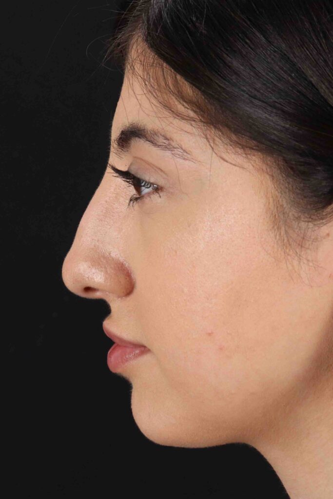 Before - left_lateral