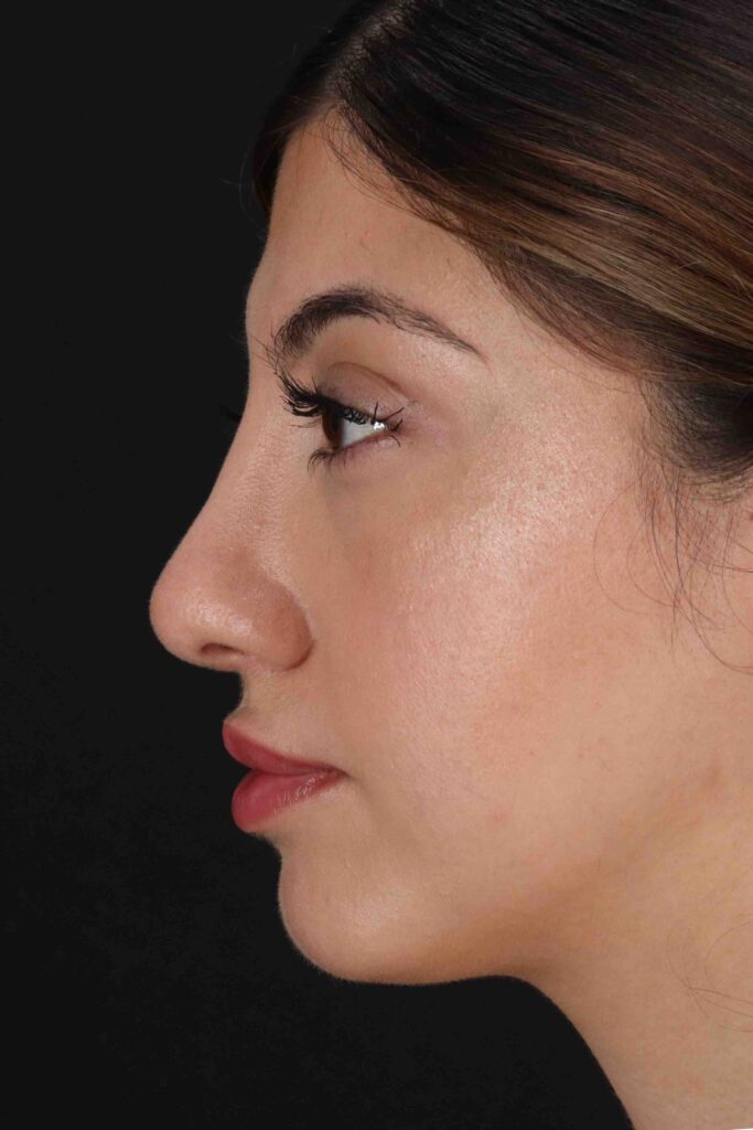 After - left_lateral