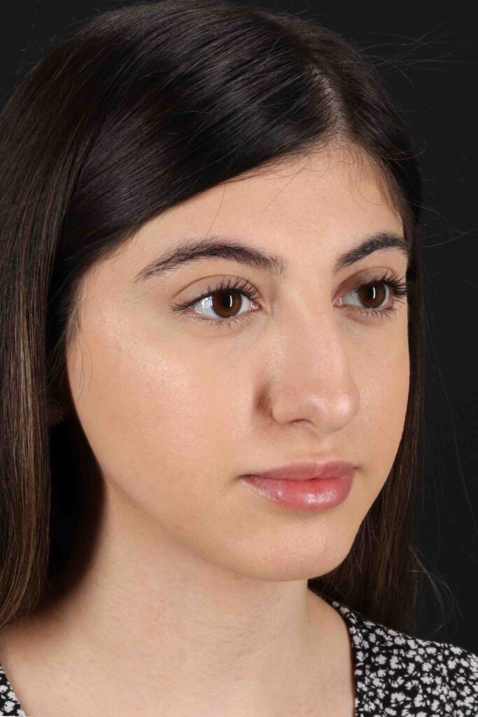 Before - right_oblique