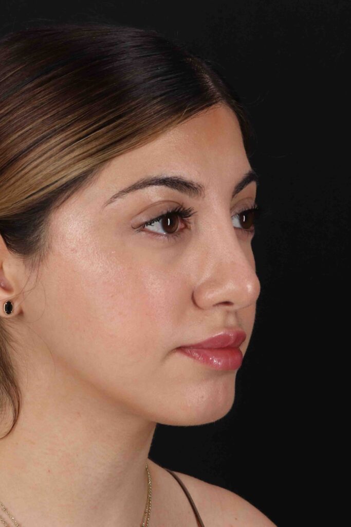 After - right_oblique