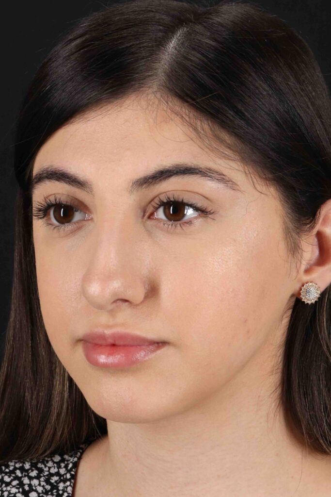 Before - left_oblique