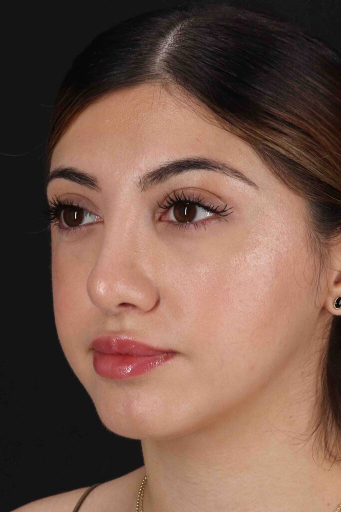 After - left_oblique