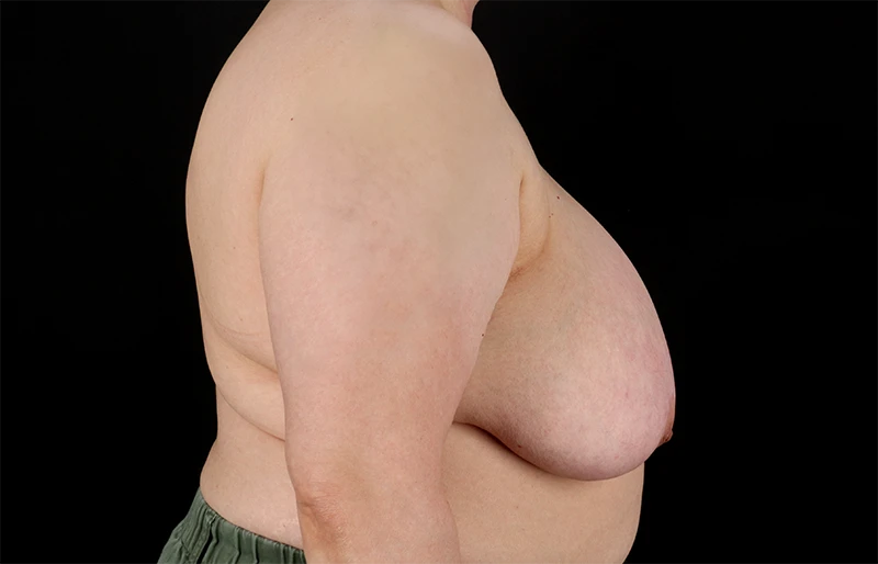 Before - right_lateral