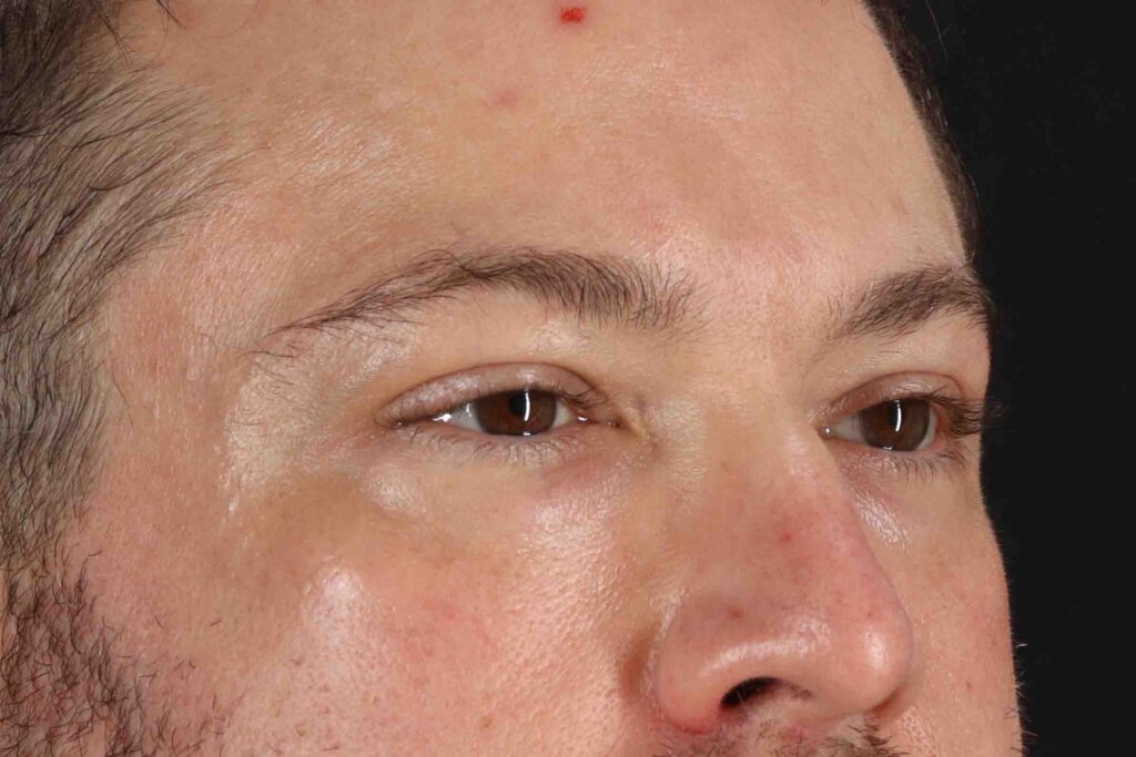 Before - right_oblique