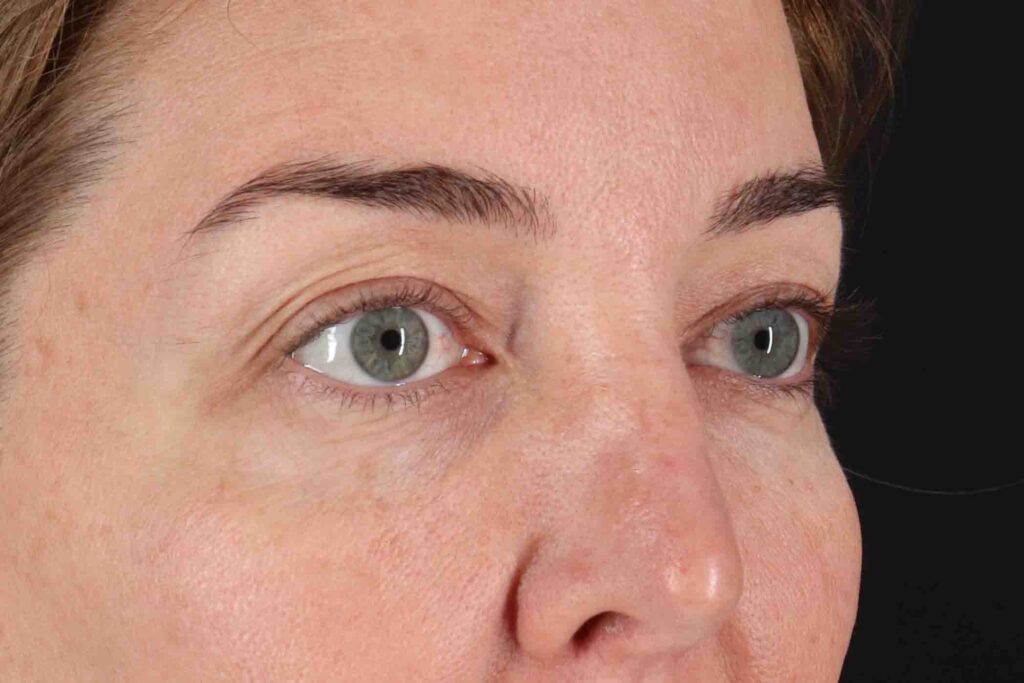 Before - right_oblique