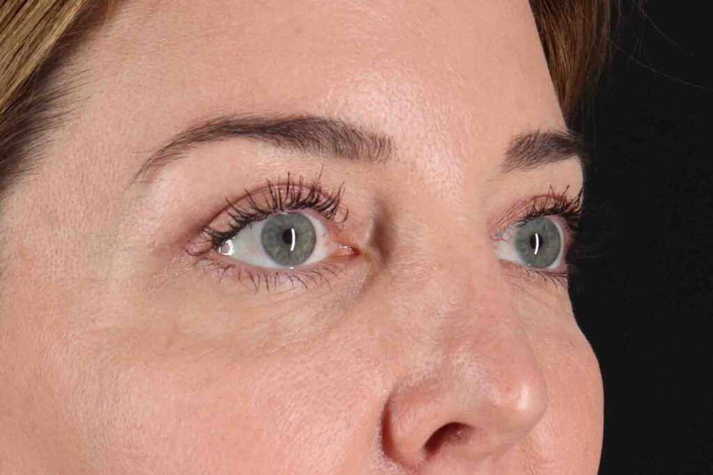 After - right_oblique