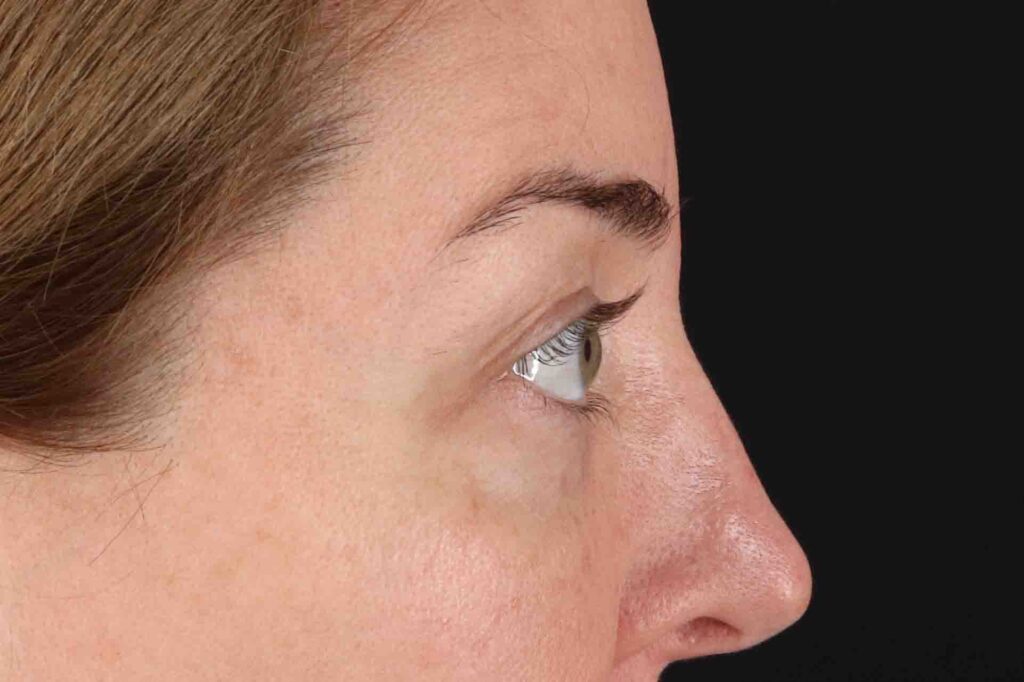 Before - right_lateral