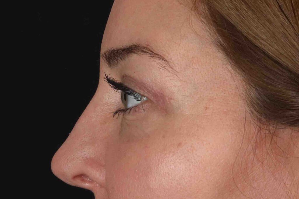 After - left_lateral