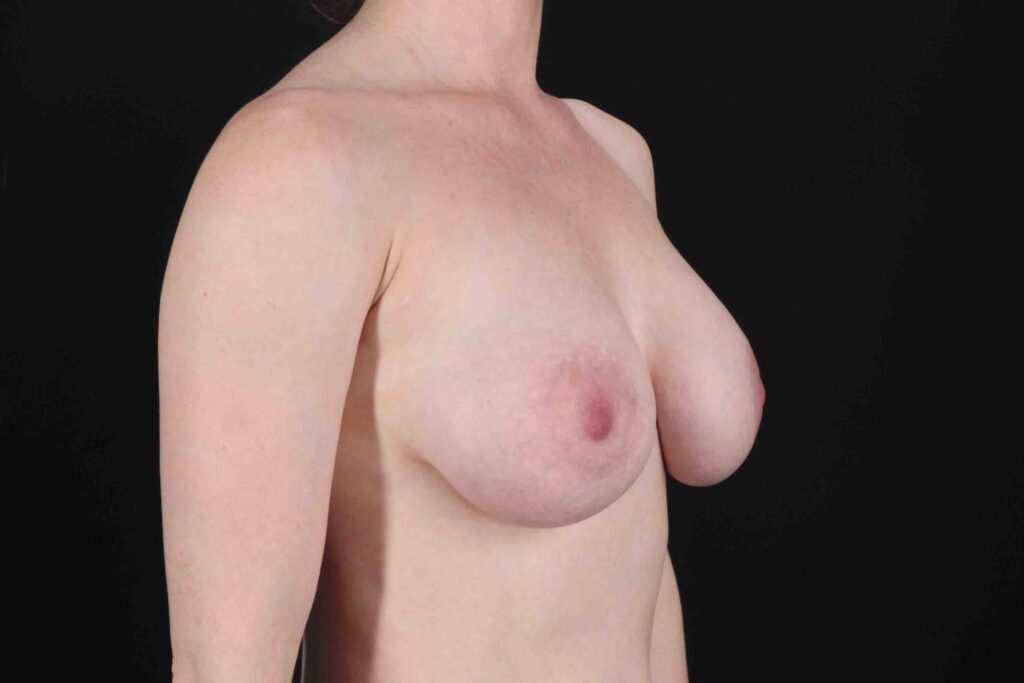 After - right_oblique