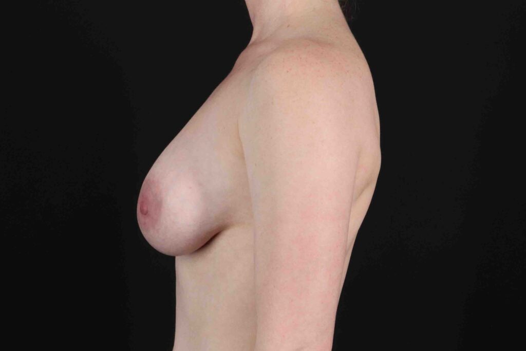 After - left_lateral