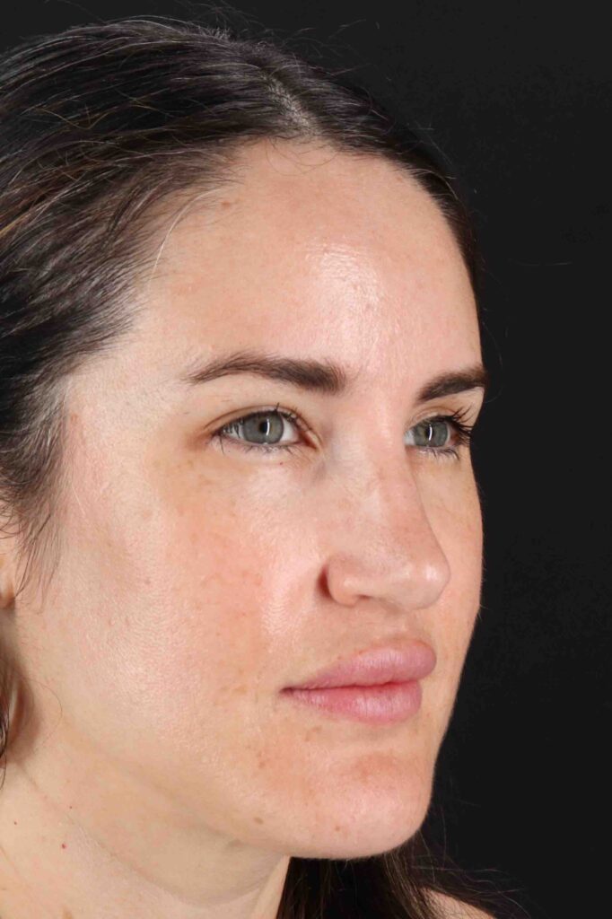 After - right_oblique