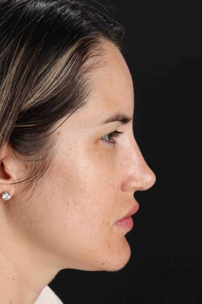 Before - right_lateral