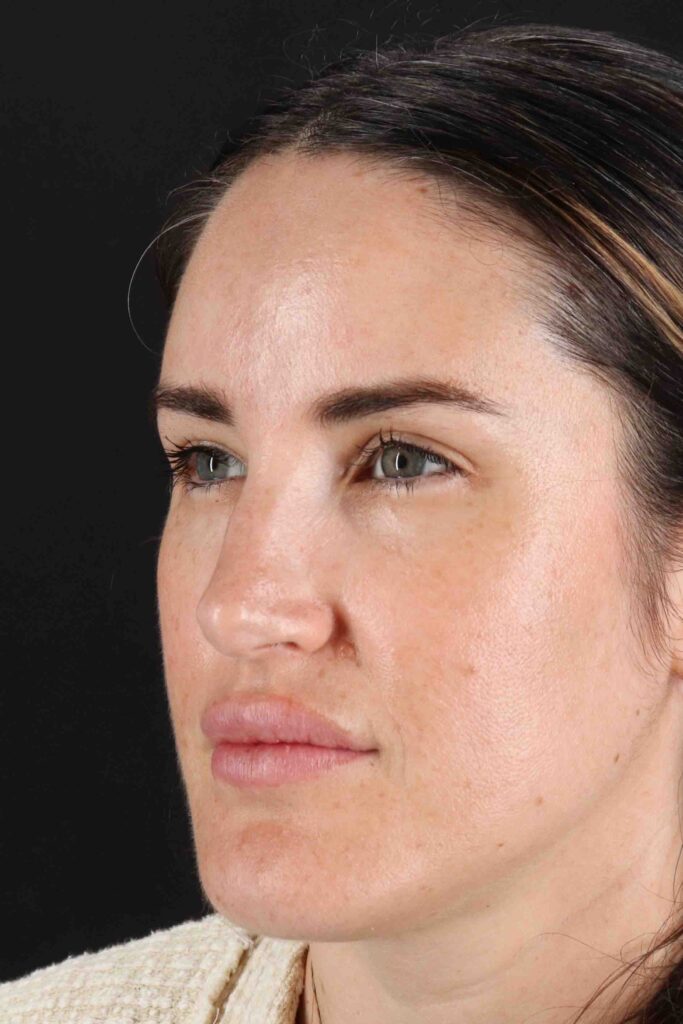 After - left_oblique