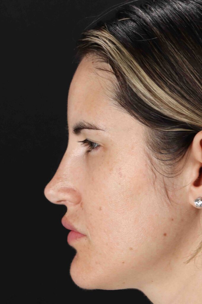 Before - left_lateral