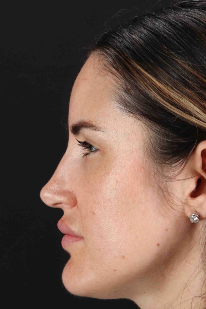 After - left_lateral