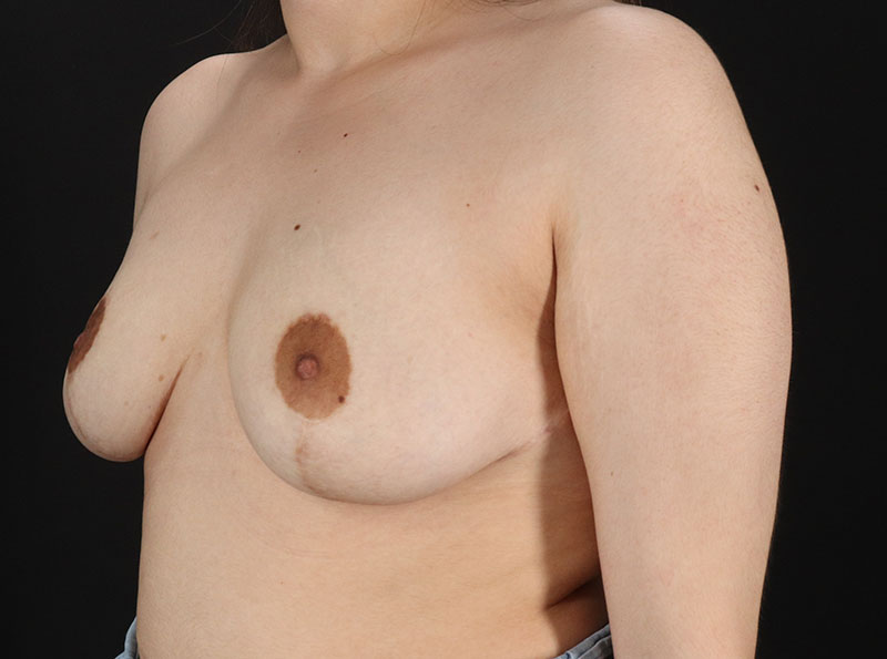 After - left_oblique