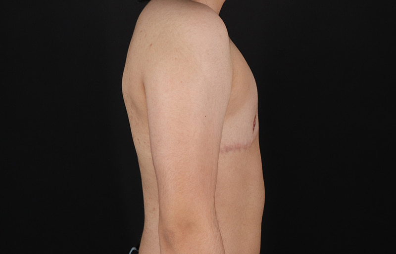 After - right_lateral