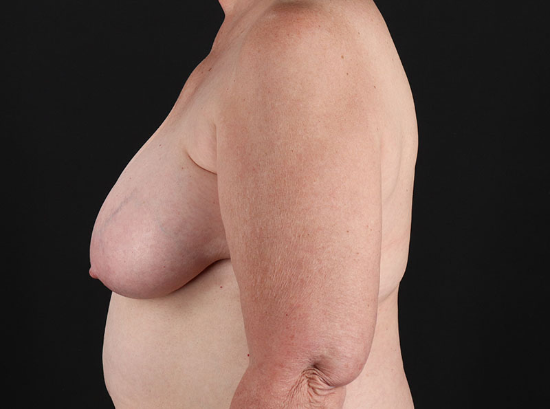 Before - left_lateral