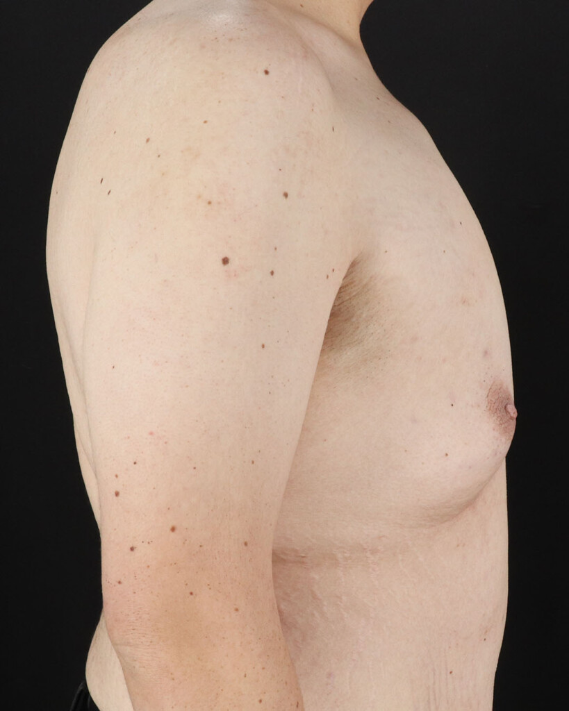 Before - right_lateral