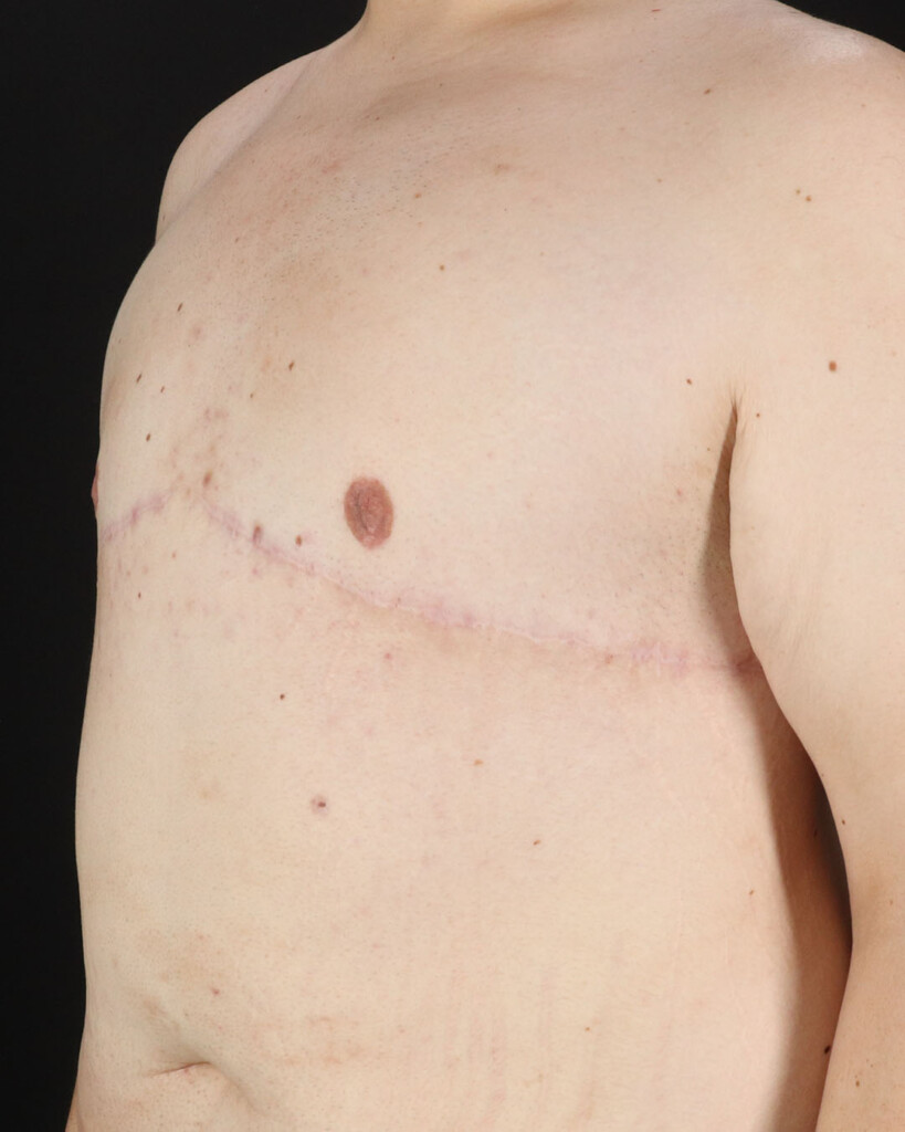 After - left_oblique