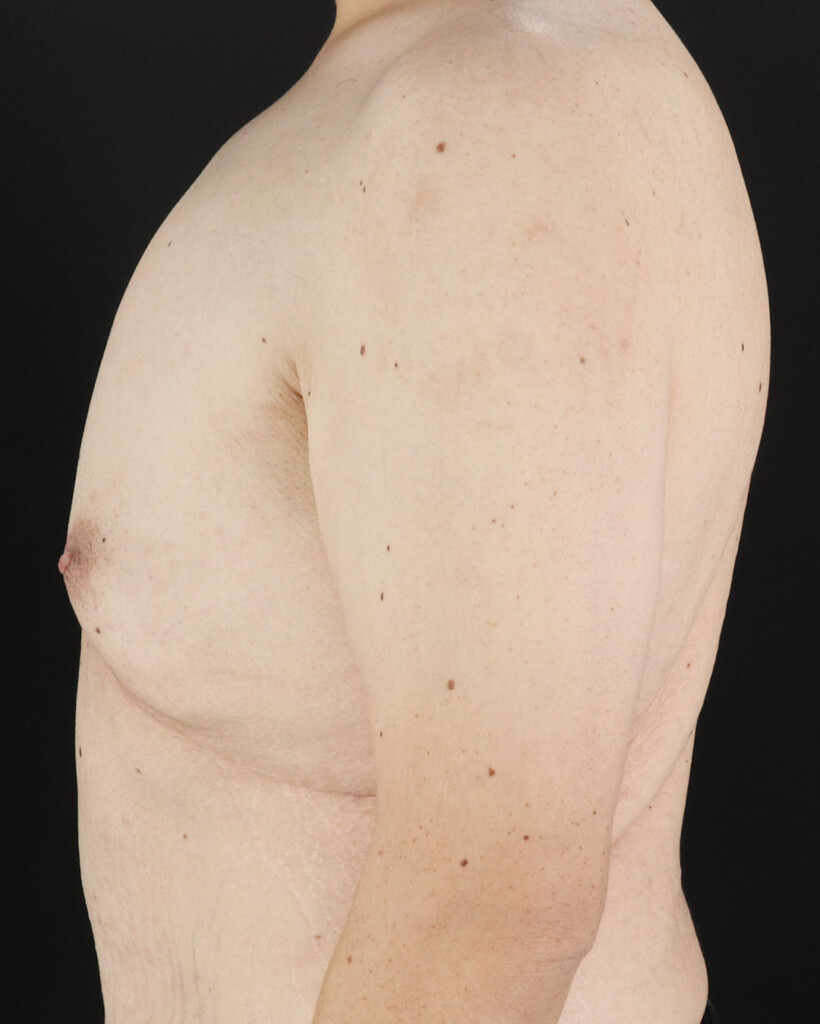 Before - left_lateral