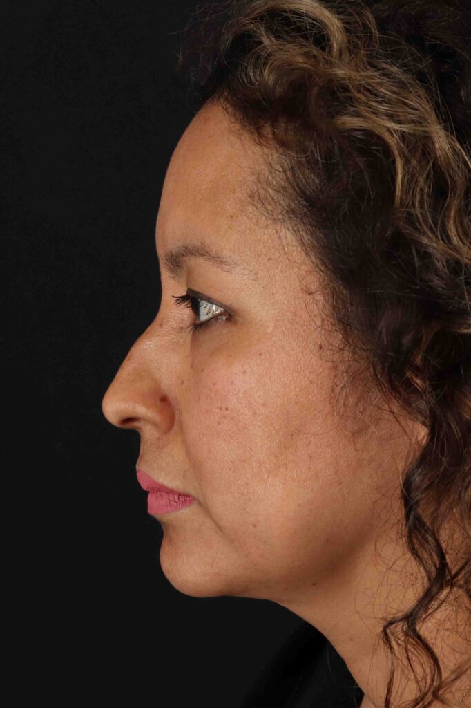 Before - left_lateral