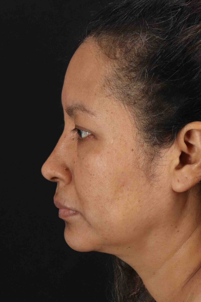 After - left_lateral