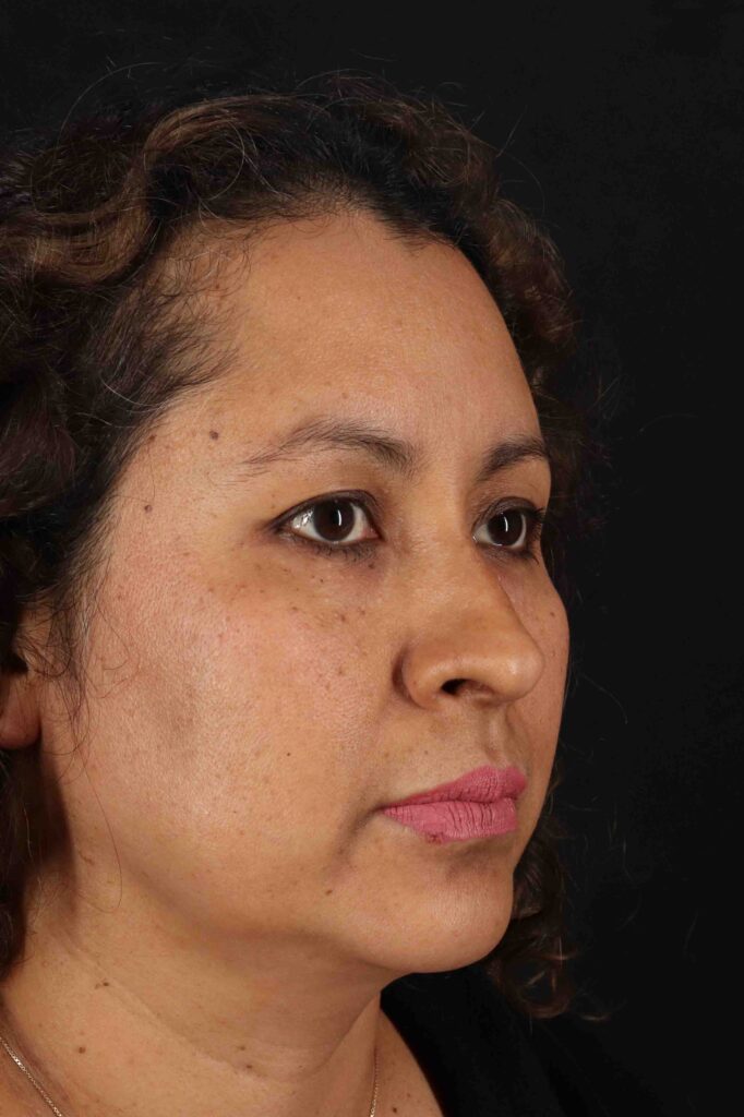 Before - right_oblique