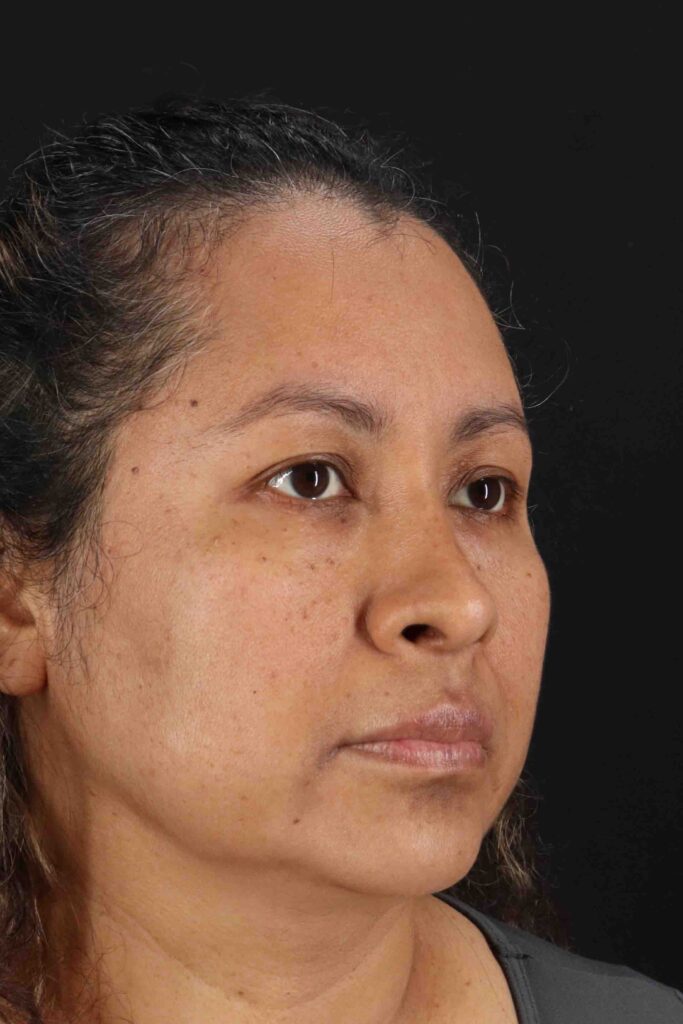 After - right_oblique