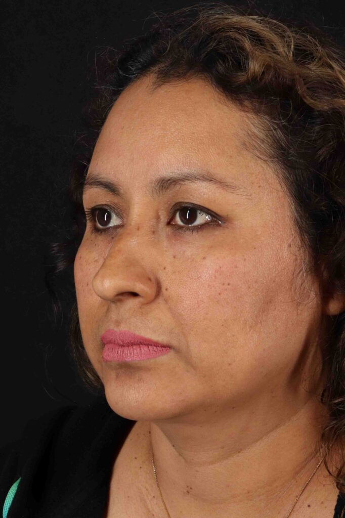 Before - left_oblique