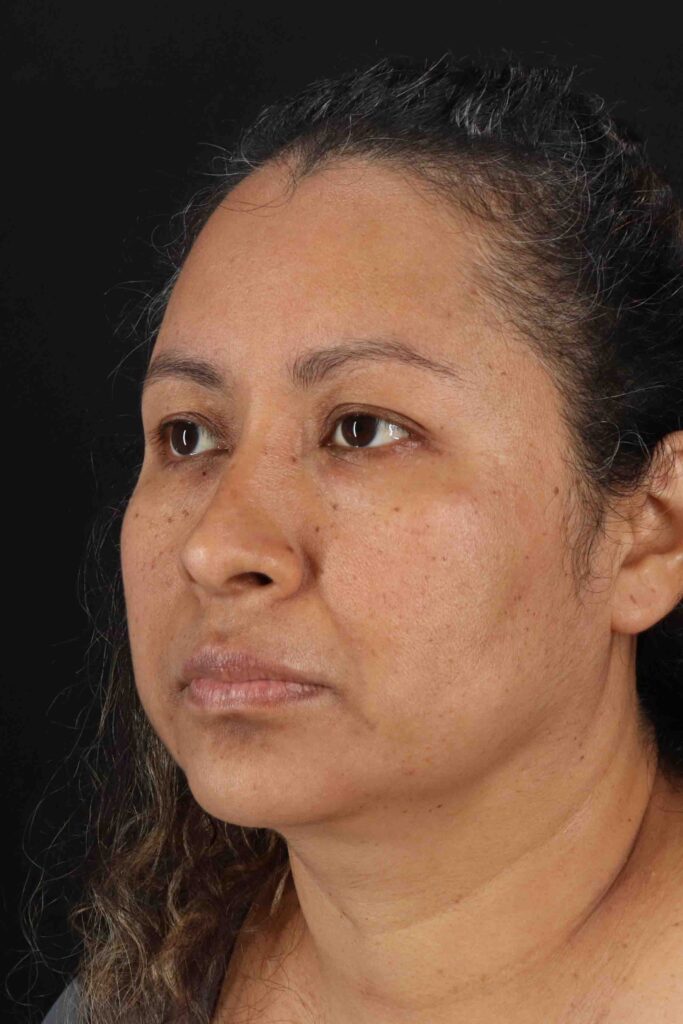 After - left_oblique