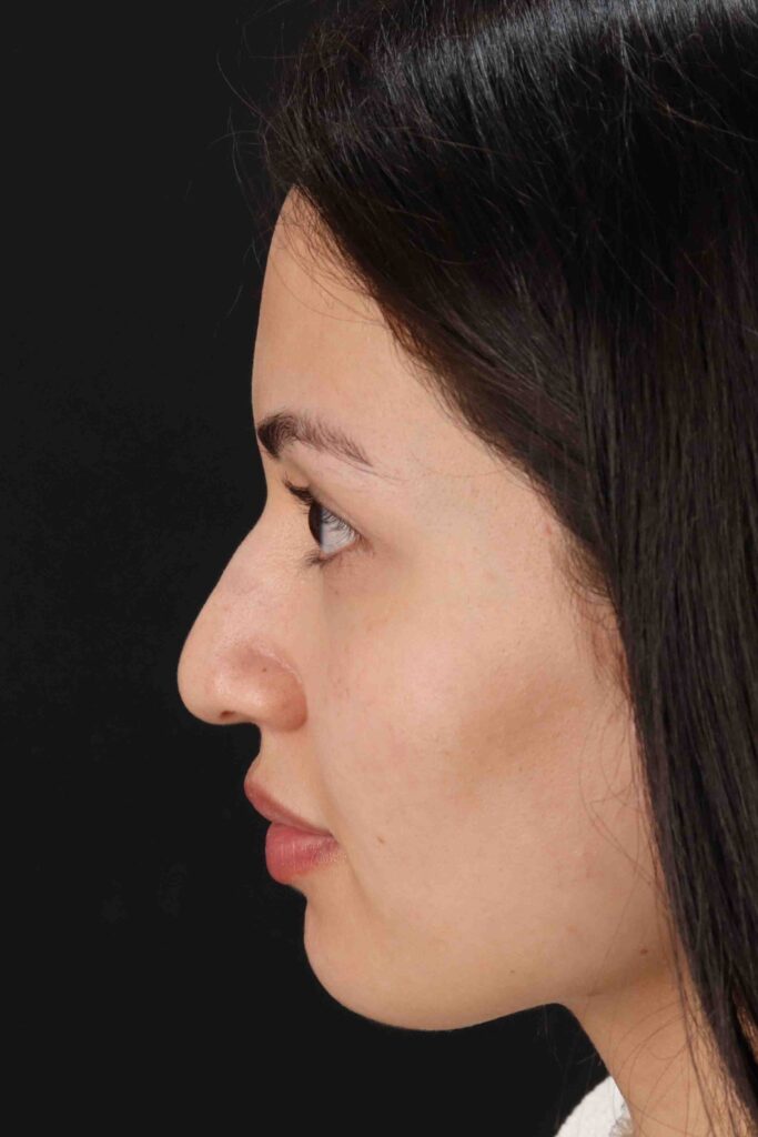 Before - left_lateral