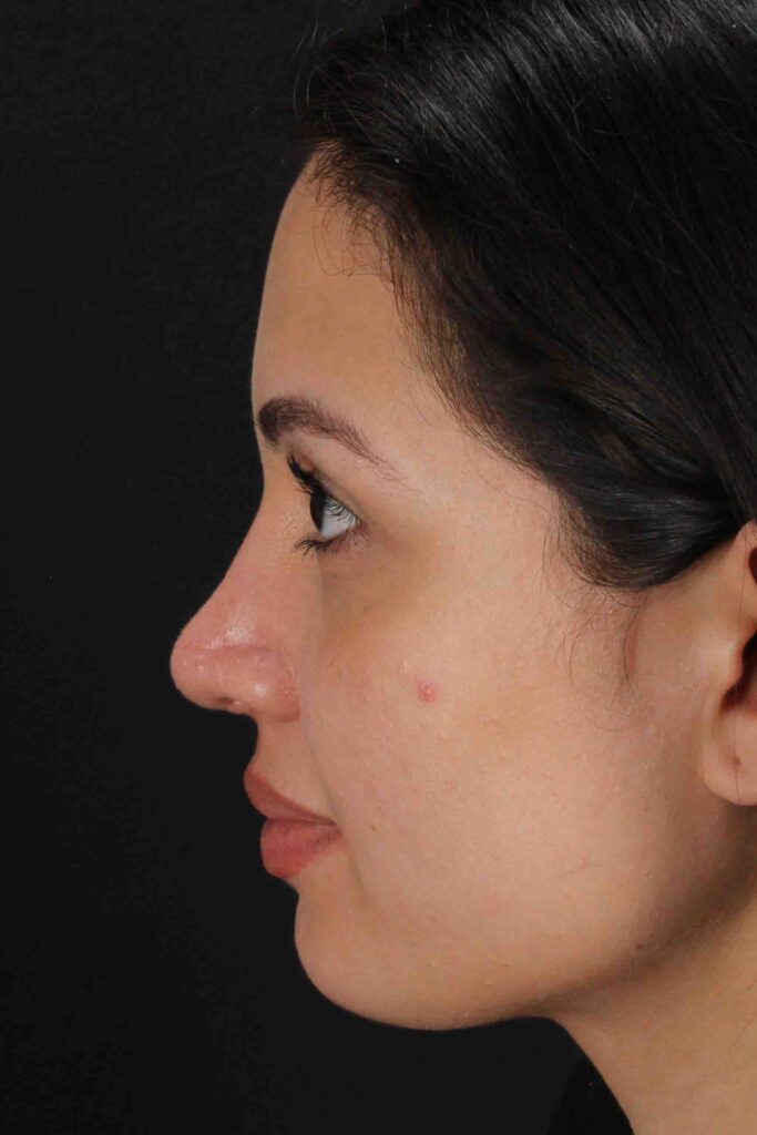 After - left_lateral