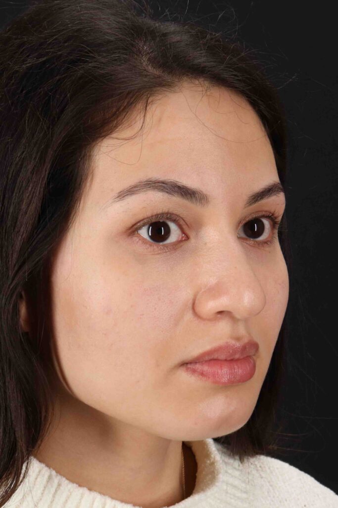 Before - right_oblique