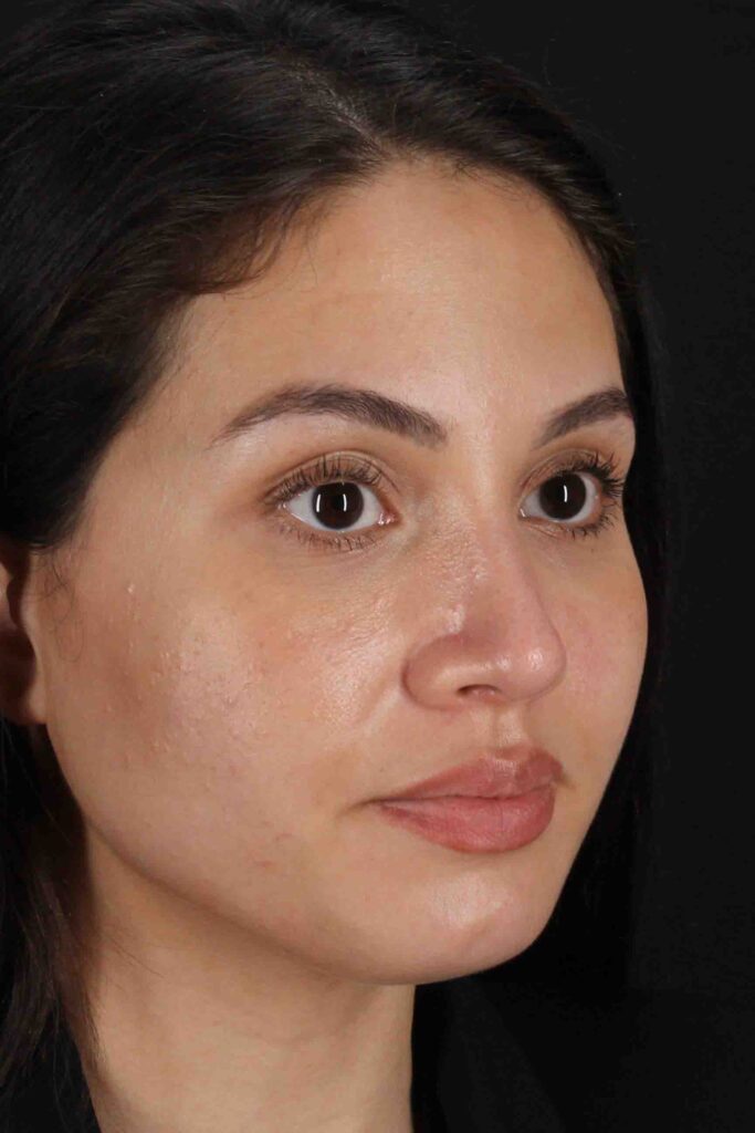 After - right_oblique