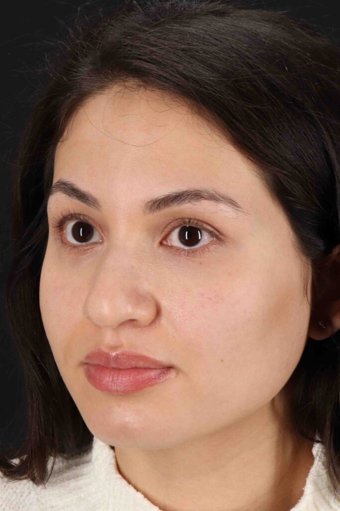 Before - left_oblique