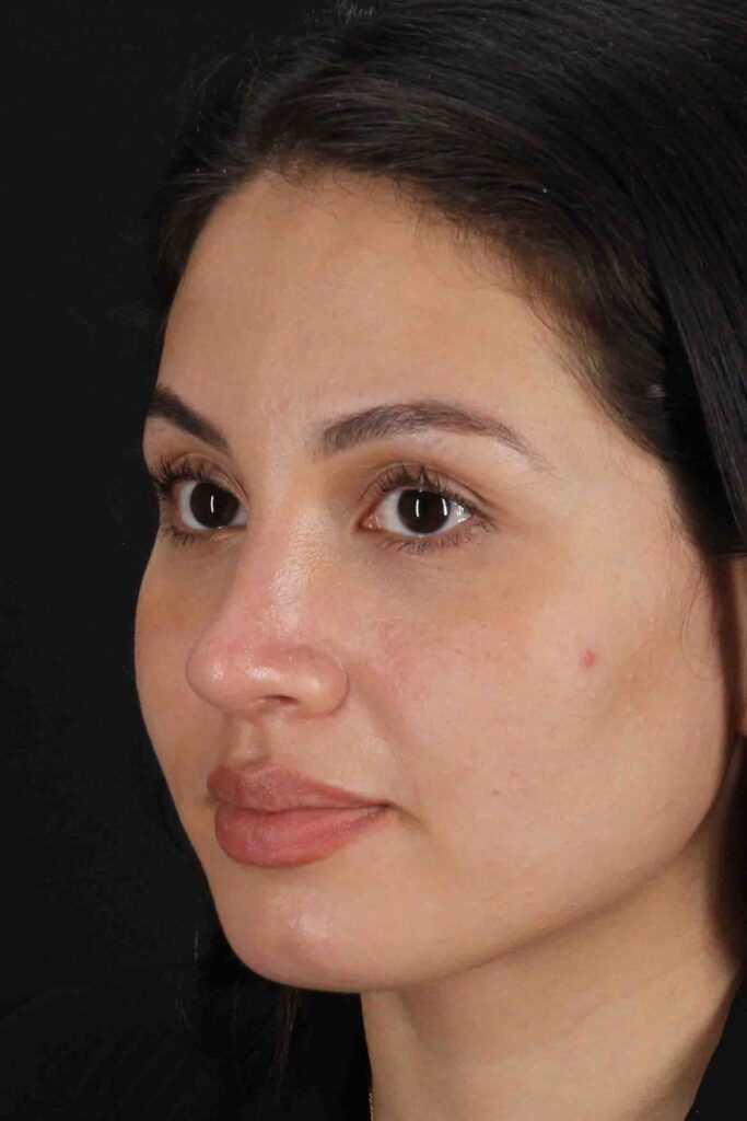 After - left_oblique