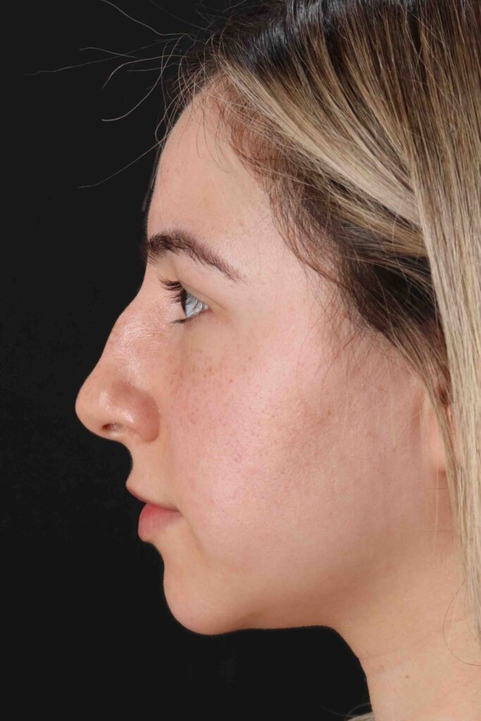 Before - left_lateral