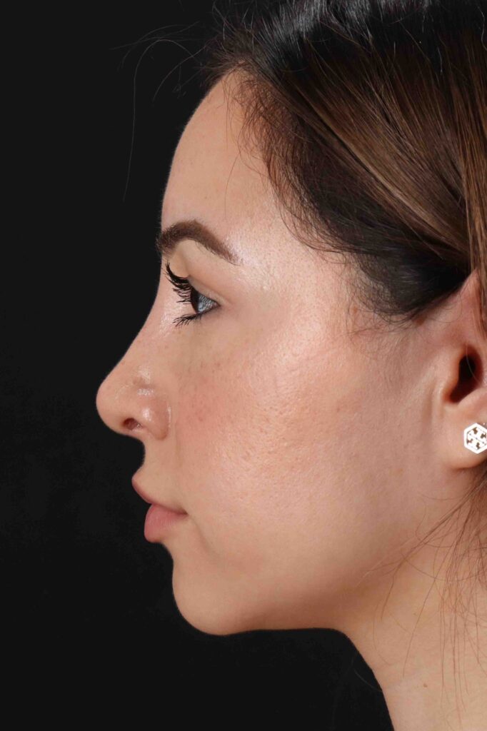 After - left_lateral