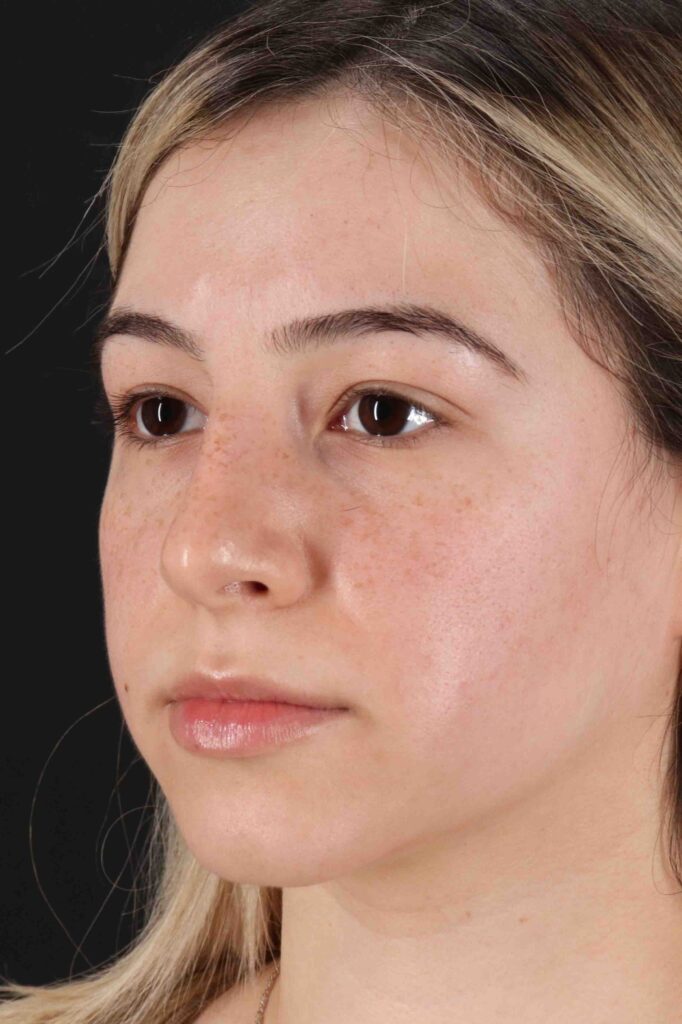 Before - left_oblique