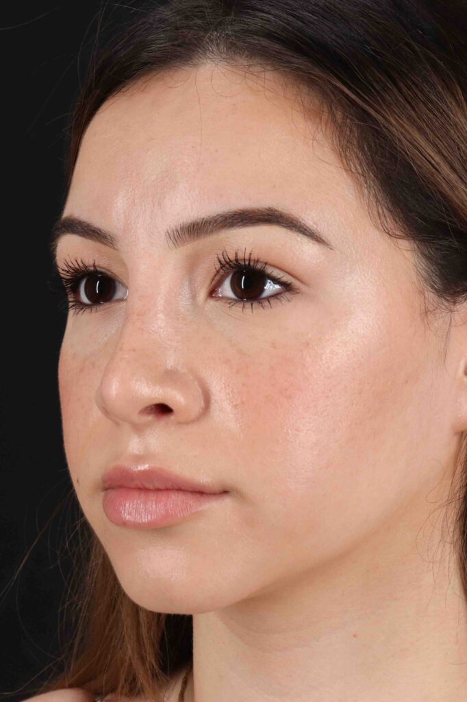 After - left_oblique