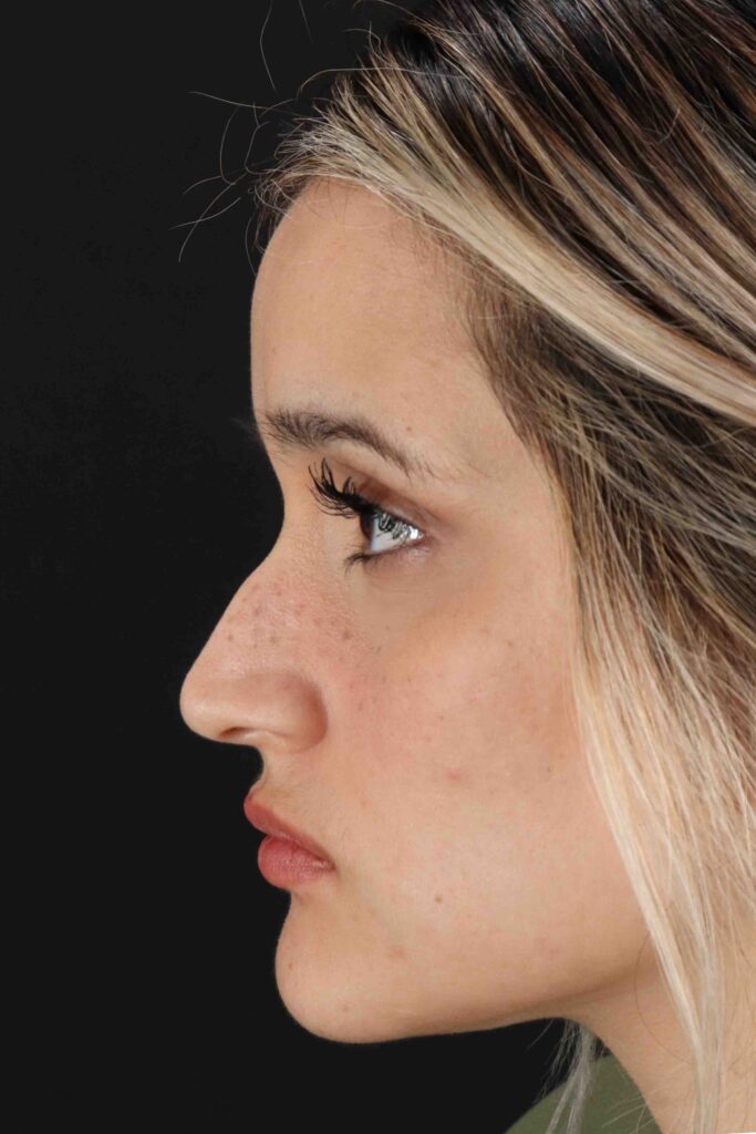 Before - left_lateral