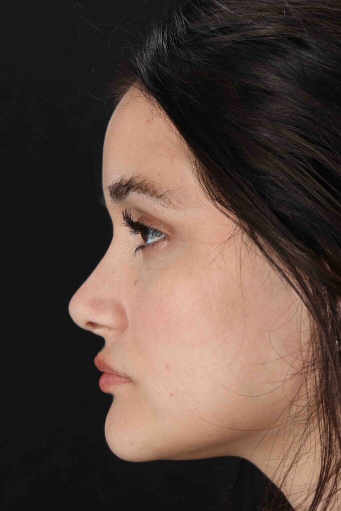 After - left_lateral